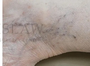 Vascular Reduction Before & After Patient #7919