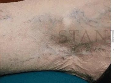 Vascular Reduction Before & After Patient #7919