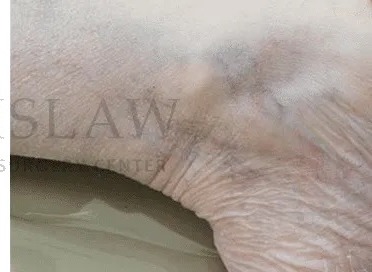 Vascular Reduction Before & After Patient #7919