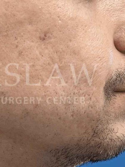 Acne Scarring Before & After Patient #7860