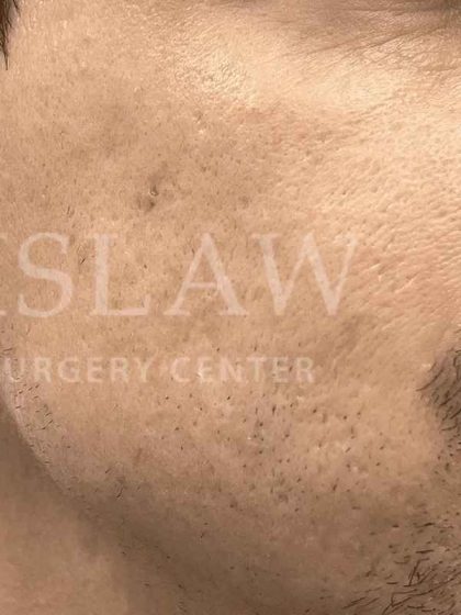 Acne Scarring Before & After Patient #7860