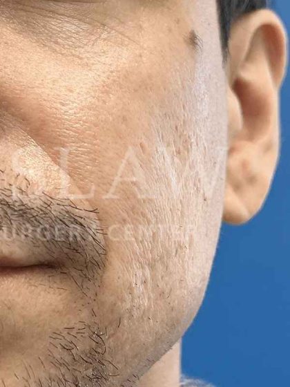 Acne Scarring Before & After Patient #7860