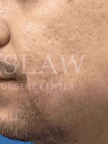 Acne Scarring Before & After Patient #7860