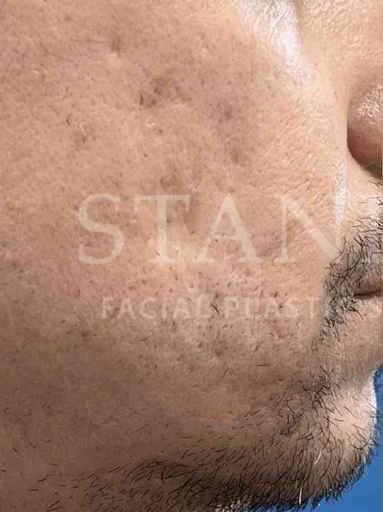 Acne Scarring Before & After Patient #7860
