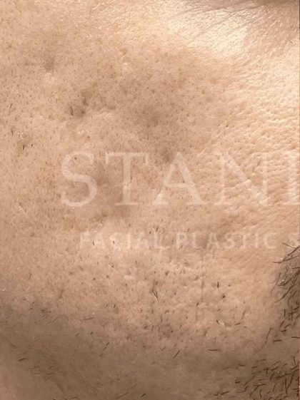 Acne Scarring Before & After Patient #7860
