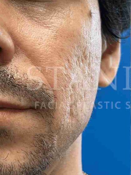 Acne Scarring Before & After Patient #7860