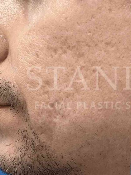 Acne Scarring Before & After Patient #7860