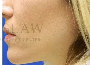 Acne Scarring Before & After Patient #7851