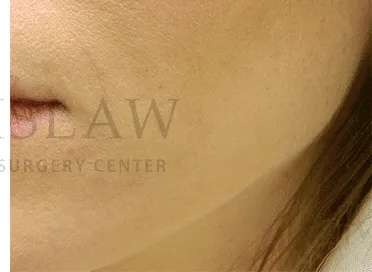 Acne Scarring Before & After Patient #7851