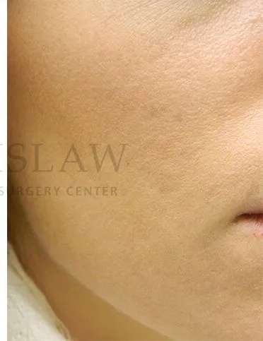 Acne Scarring Before & After Patient #7851