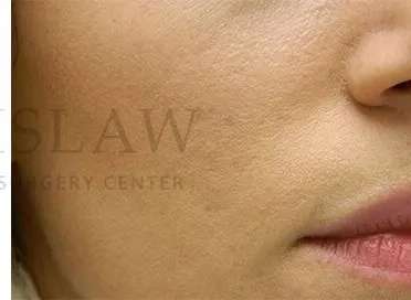 Acne Scarring Before & After Patient #7851