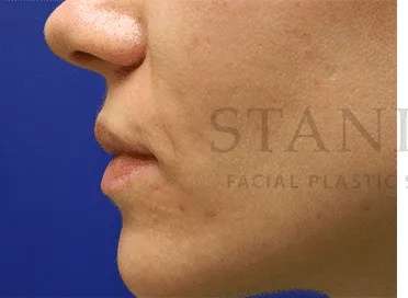 Acne Scarring Before & After Patient #7851