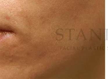 Acne Scarring Before & After Patient #7851