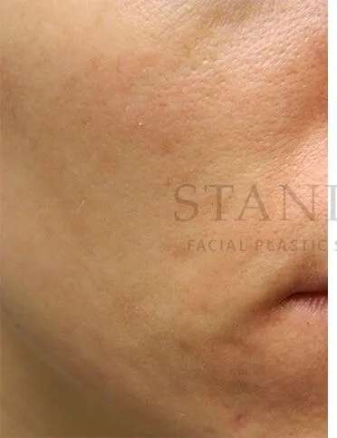 Acne Scarring Before & After Patient #7851