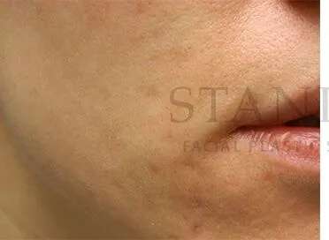 Acne Scarring Before & After Patient #7851