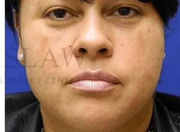 Acne Scarring Before & After Patient #7842
