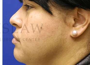 Acne Scarring Before & After Patient #7842