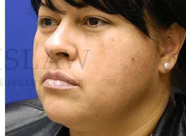 Acne Scarring Before & After Patient #7842