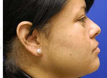 Acne Scarring Before & After Patient #7842