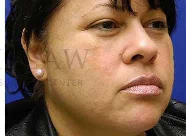 Acne Scarring Before & After Patient #7842