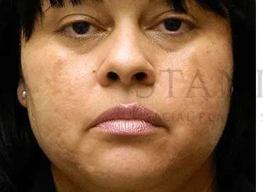 Acne Scarring Before & After Patient #7842