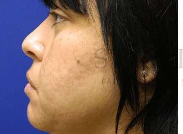 Acne Scarring Before & After Patient #7842