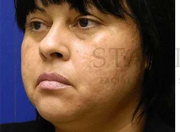 Acne Scarring Before & After Patient #7842