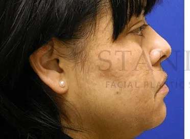 Acne Scarring Before & After Patient #7842