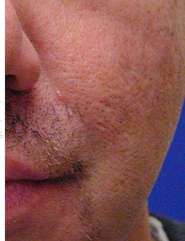 Acne Scarring Before & After Patient #7831