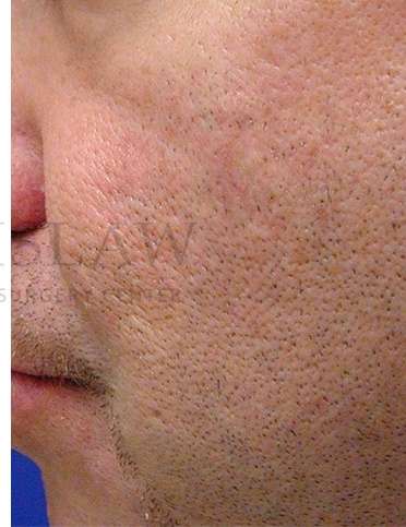 Acne Scarring Before & After Patient #7831