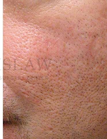 Acne Scarring Before & After Patient #7831