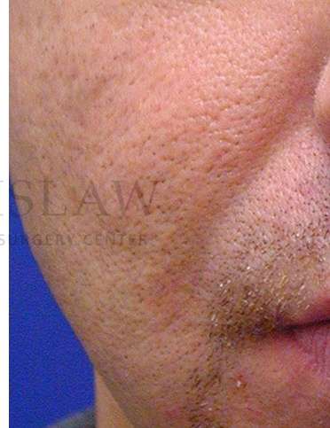 Acne Scarring Before & After Patient #7831