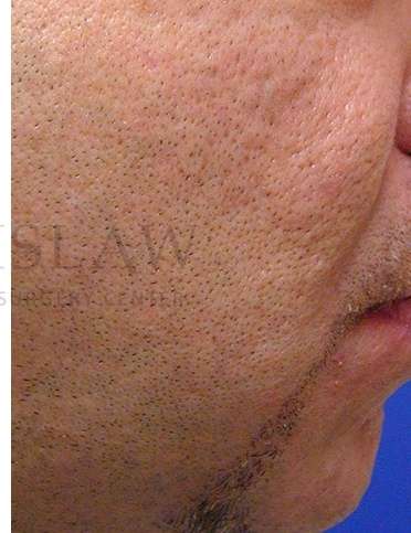 Acne Scarring Before & After Patient #7831