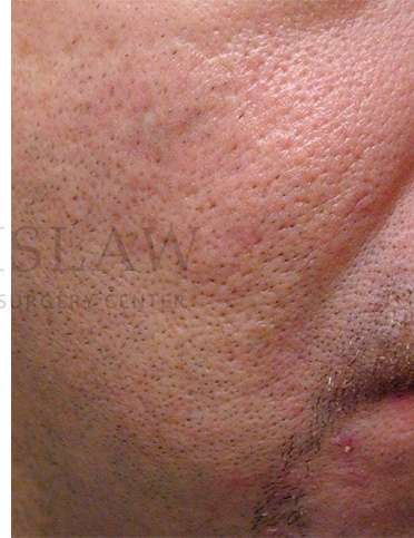 Acne Scarring Before & After Patient #7831