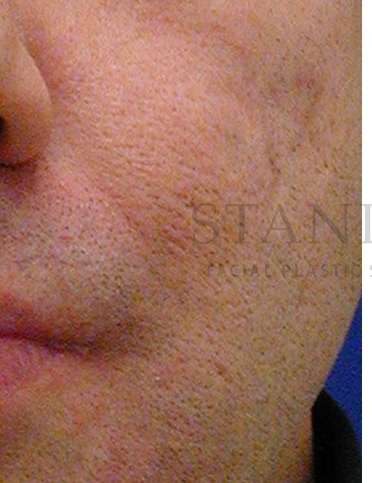 Acne Scarring Before & After Patient #7831