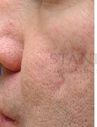 Acne Scarring Before & After Patient #7831