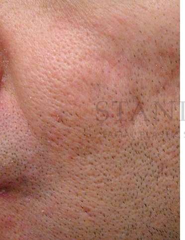 Acne Scarring Before & After Patient #7831