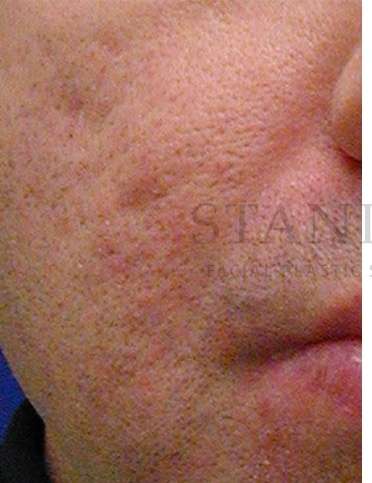 Acne Scarring Before & After Patient #7831