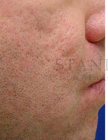 Acne Scarring Before & After Patient #7831