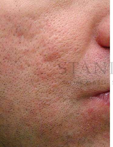 Acne Scarring Before & After Patient #7831
