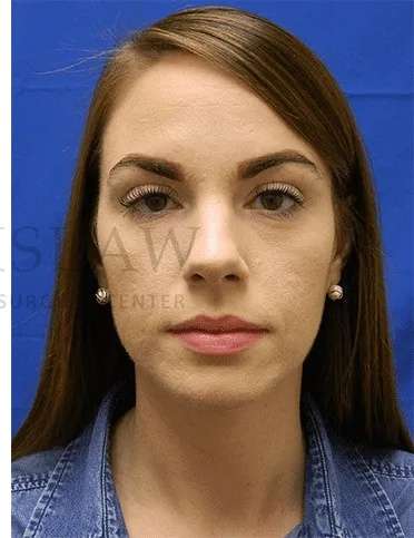 Acne Scarring Before & After Patient #7818