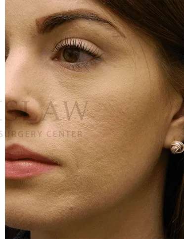 Acne Scarring Before & After Patient #7818