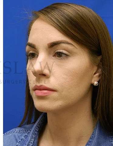 Acne Scarring Before & After Patient #7818