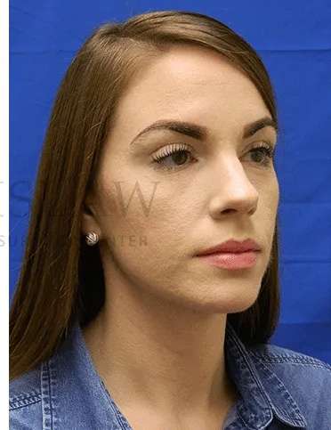 Acne Scarring Before & After Patient #7818