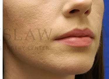 Acne Scarring Before & After Patient #7818