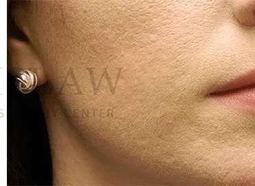 Acne Scarring Before & After Patient #7818