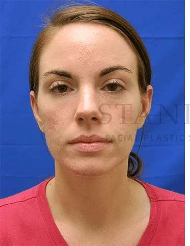 Acne Scarring Before & After Patient #7818