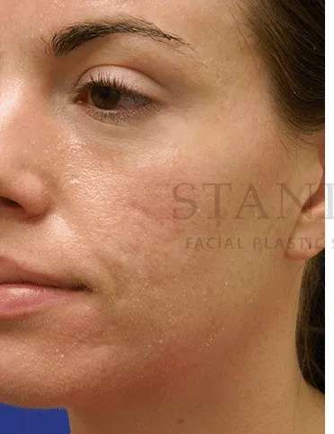 Acne Scarring Before & After Patient #7818