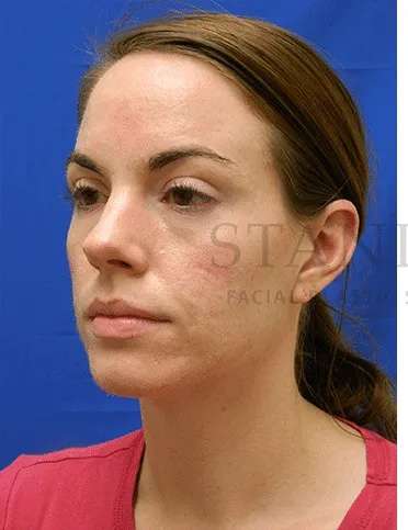 Acne Scarring Before & After Patient #7818