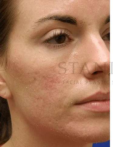 Acne Scarring Before & After Patient #7818